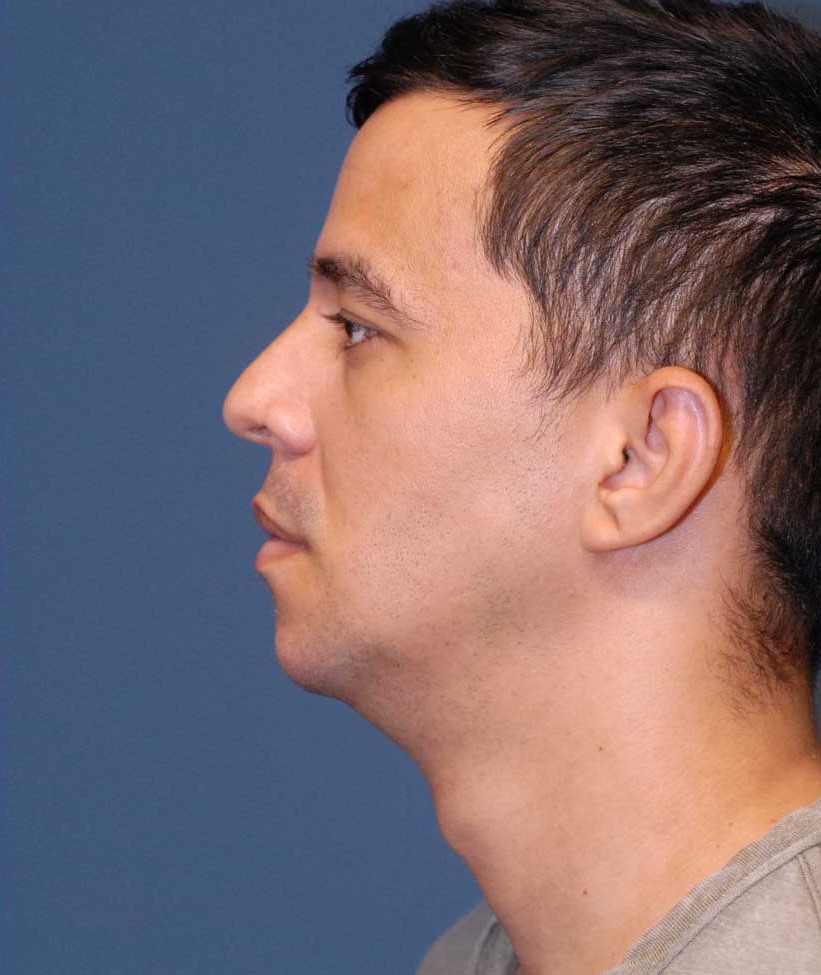 Male Facial Rejuvenation  Before & After Image