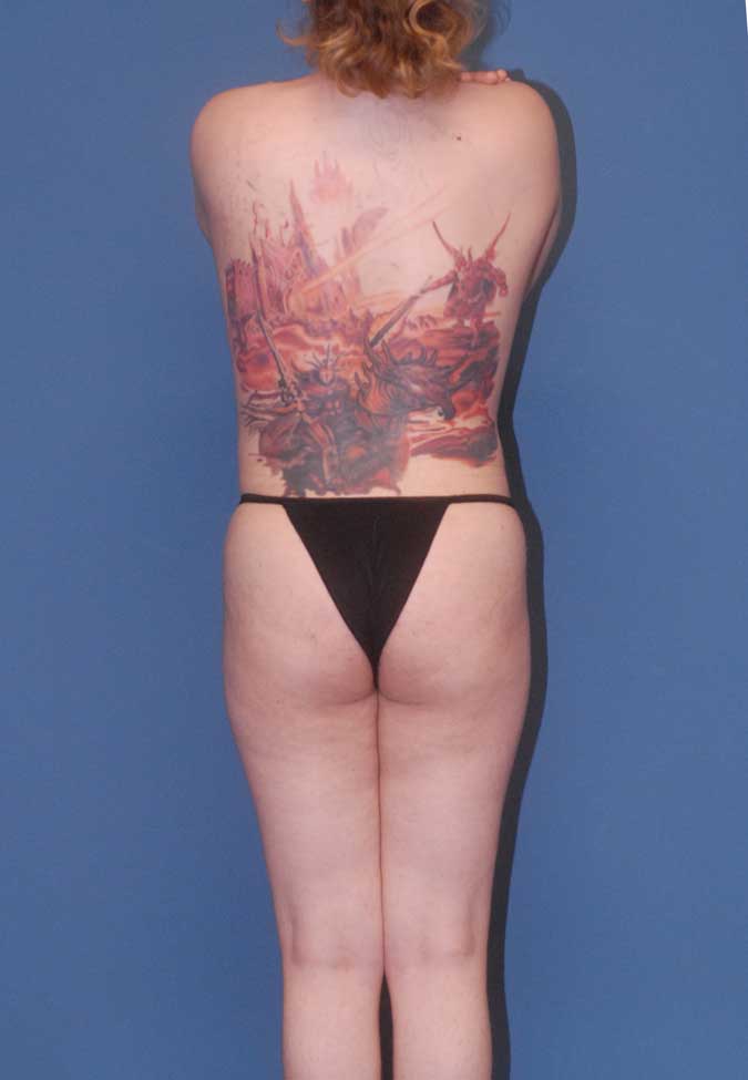 Male To Female Body Contouring Before & After Image
