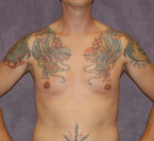 Male To Female Breast Contouring Before & After Image