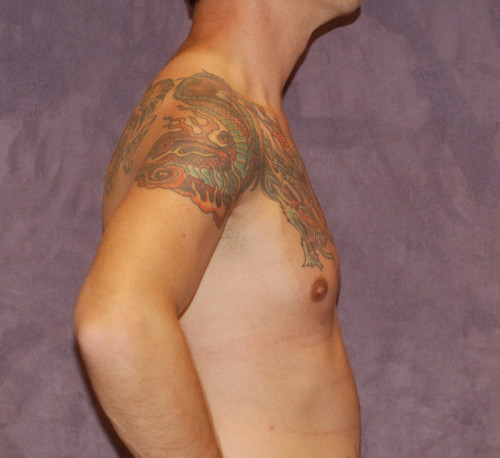 Male To Female Breast Contouring Before & After Image