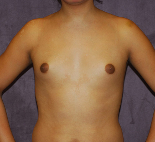 Male To Female Breast Contouring Before & After Image