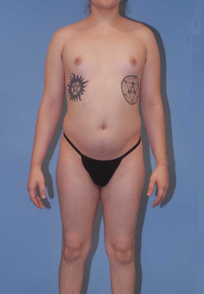 Male To Female Breast Contouring Before & After Image