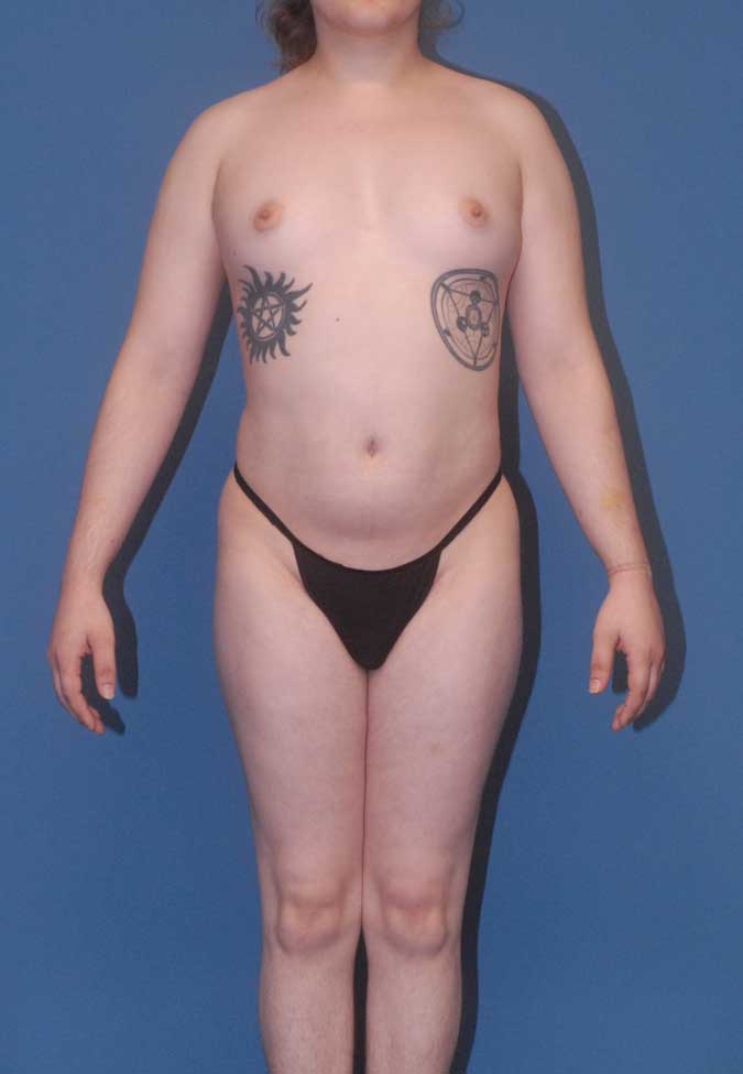 Male To Female Breast Contouring Before & After Image