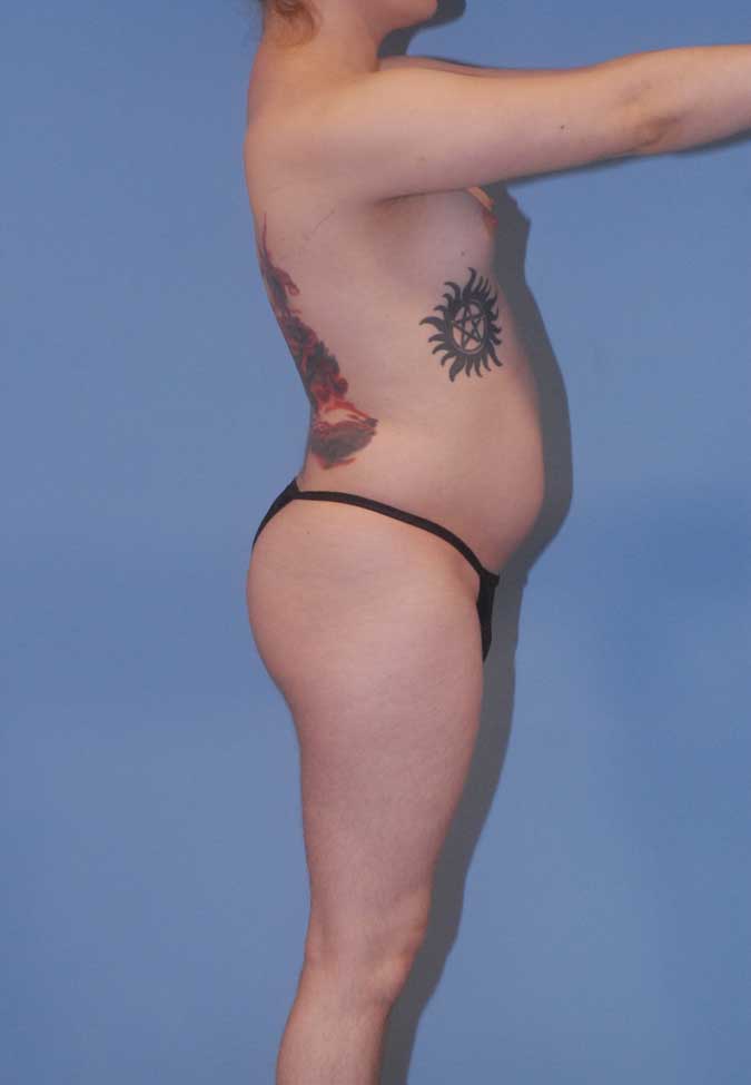 Male To Female Breast Contouring Before & After Image