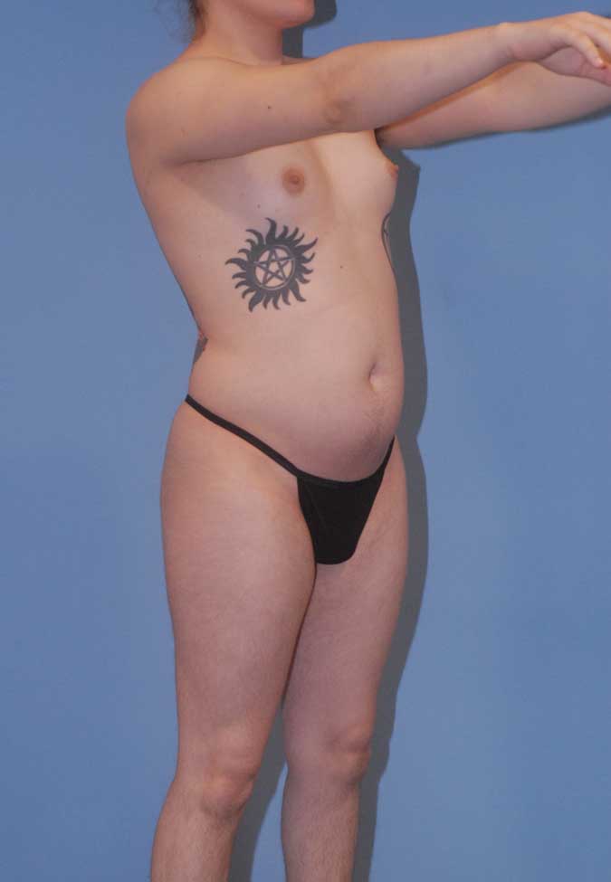 Male To Female Breast Contouring Before & After Image