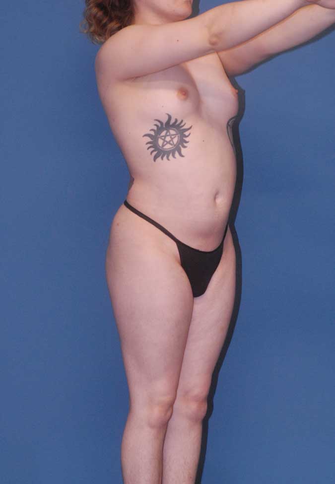 Male To Female Breast Contouring Before & After Image