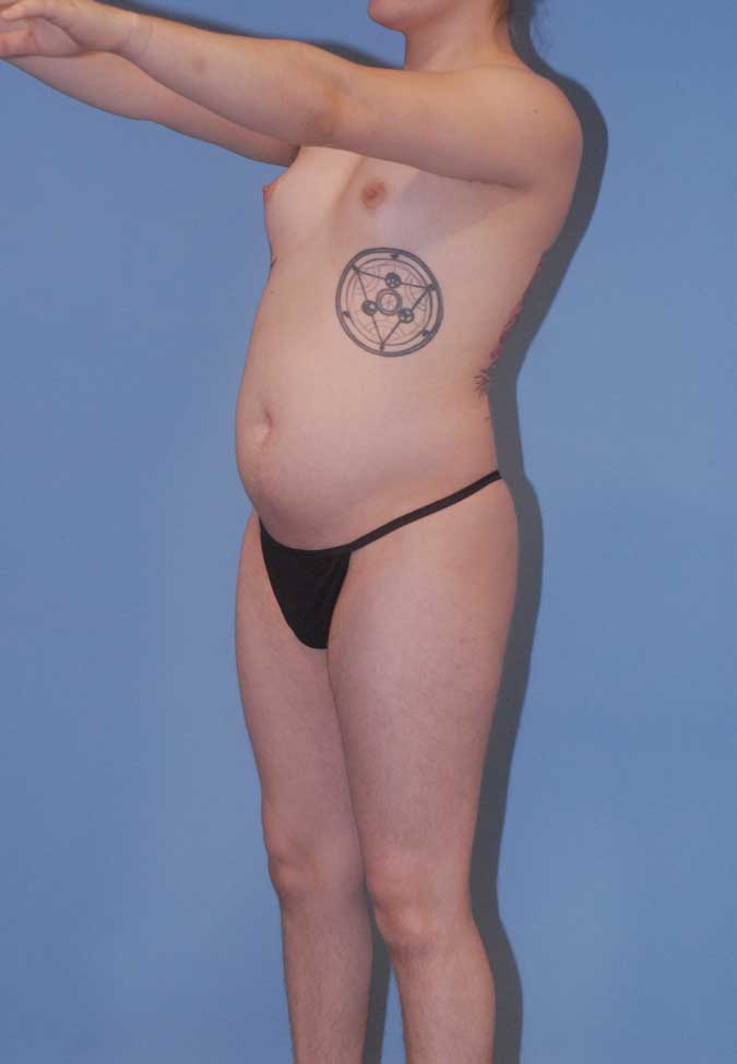 Male To Female Breast Contouring Before & After Image