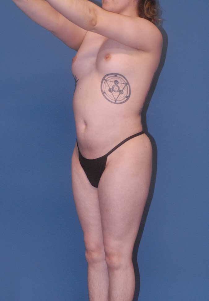 Male To Female Breast Contouring Before & After Image
