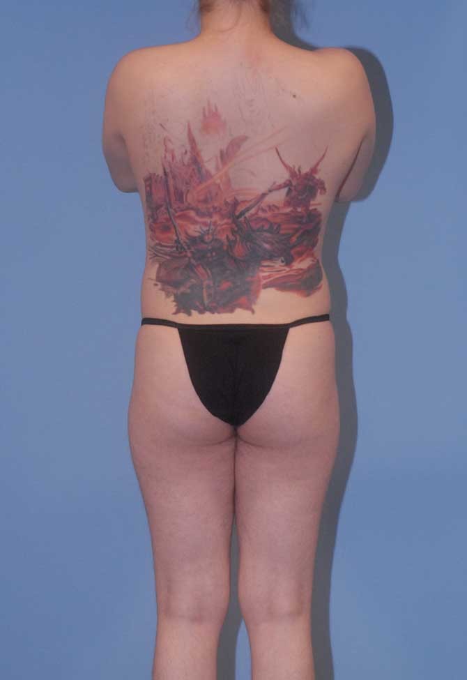 Male To Female Breast Contouring Before & After Image
