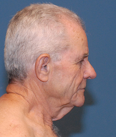 TZ Plasty Before & After Image